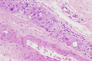 Vascular bundle with lymphatic invasion by carcinoma