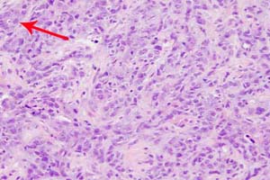 A single acinar structure is seen in the top left hand corner (arrow). Overall, tubule formation is well under 10% - Tubule score = 3