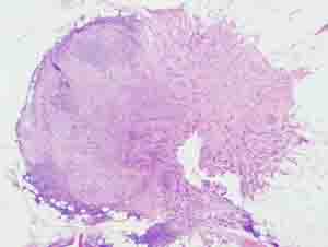 Low power view of replacement metastasis.